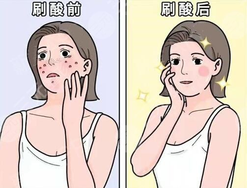 果酸换肤好不好?果酸换肤的优点