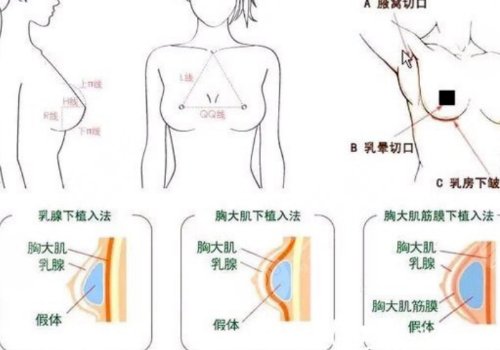 丰胸手术对身体有什么影响？