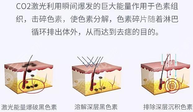 祛痣