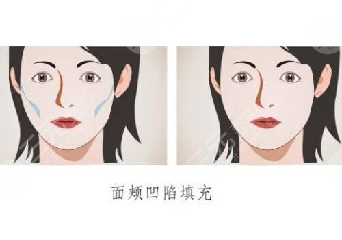 面颊凹陷怎么恢复饱满？