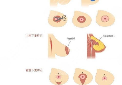 乳房悬吊术可以维持多久？