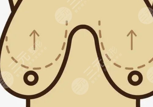 乳房悬吊术可以维持多久？