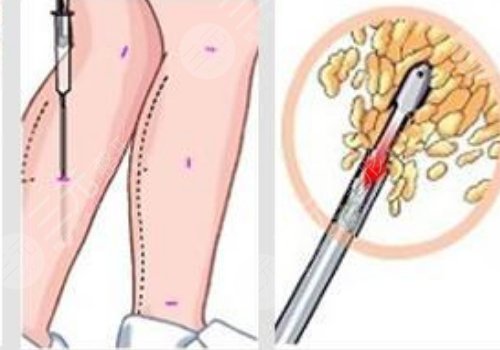 腿部吸脂手术有什么危害？