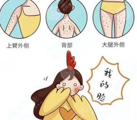 激光治疗