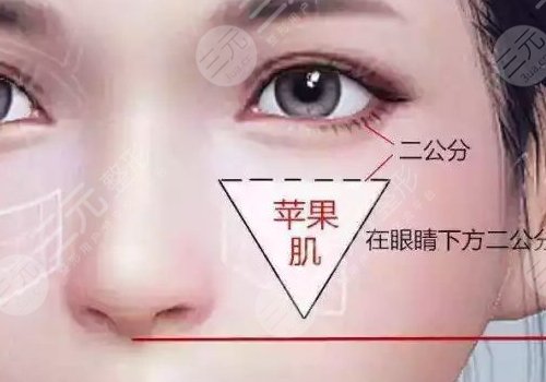 瑞蓝丽堤玻尿酸维持时间是多久？
