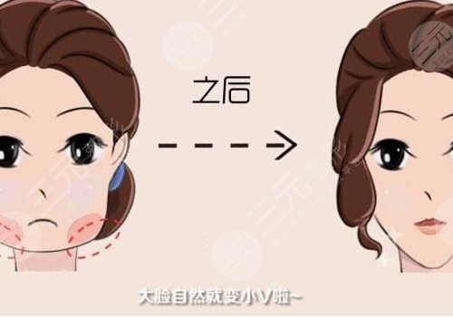 下颌缘轮廓注射多少钱？能维持多久？