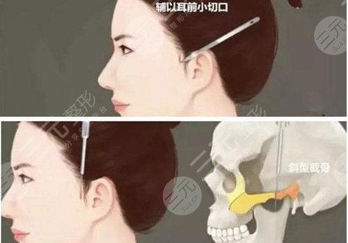 颧骨内推风险高吗？多少钱？