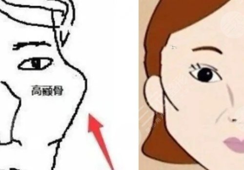 颧骨内推风险高吗？多少钱？