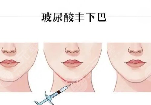 宝尼达丰下巴可以维持多久？
