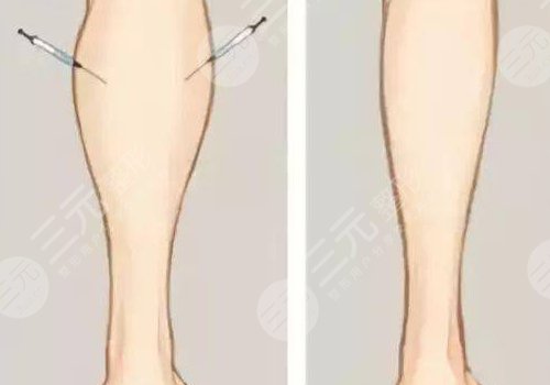 怎样瘦腿又快又有效？