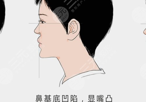 鼻基底注射后注意事项有哪些？