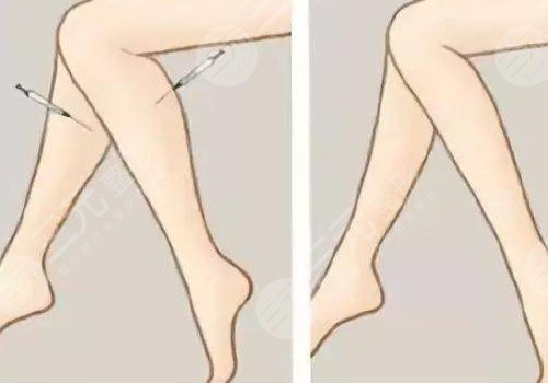 小腿吸脂后多久可以正常走路？
