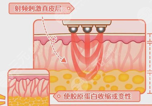热拉提plus做一次可以维持多久？