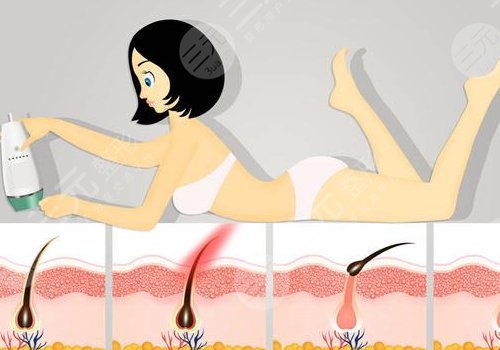 激光脱毛有副作用吗？