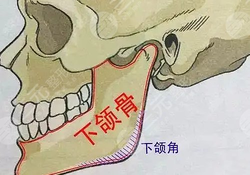 下颌角宽大怎么改善?