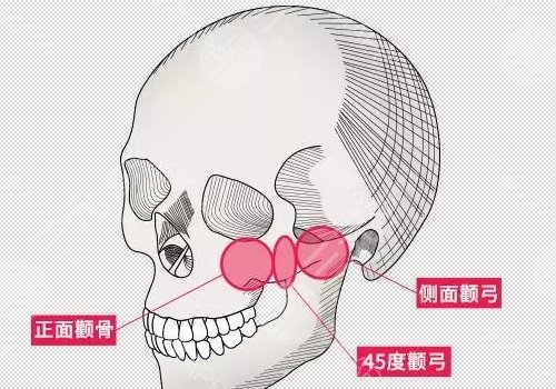 下颌角宽大怎么改善?