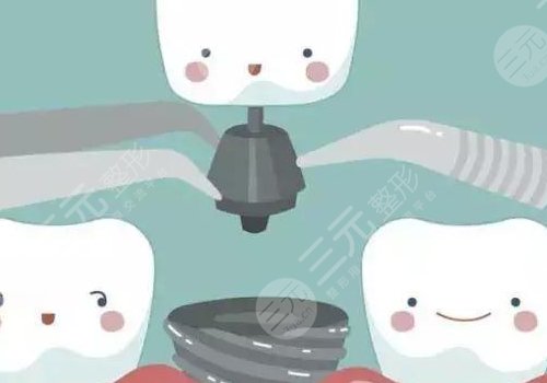 烤瓷牙多少钱一颗？