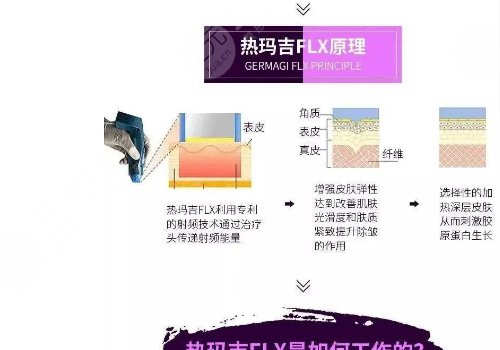 fotona4D和热玛吉的区别|哪个效果好？