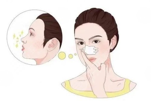 整鼻子鼻翼缩小多少钱？