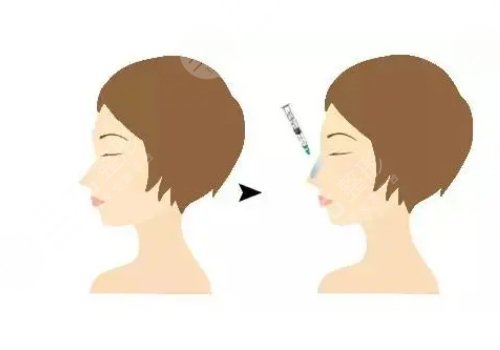 整鼻子鼻翼缩小多少钱？