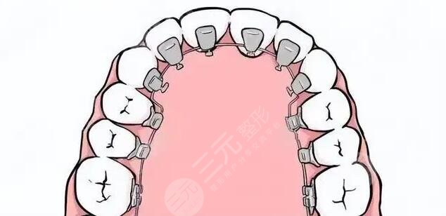 牙齿矫正相关科普