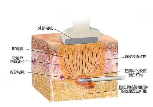 镭射溶脂有效果吗？