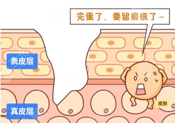 像素激光祛疤手术安全吗?