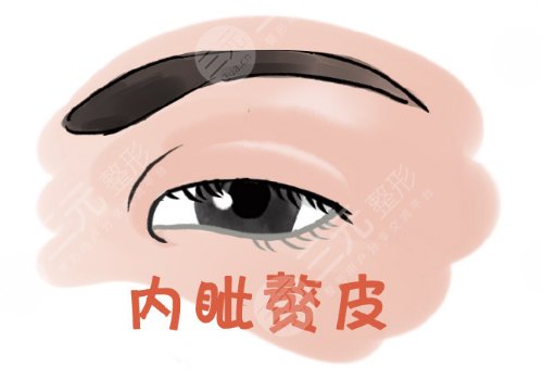 开内眼角一般多少钱？