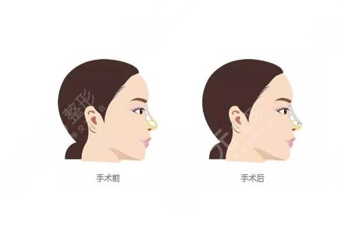鼻小柱延长原因介绍