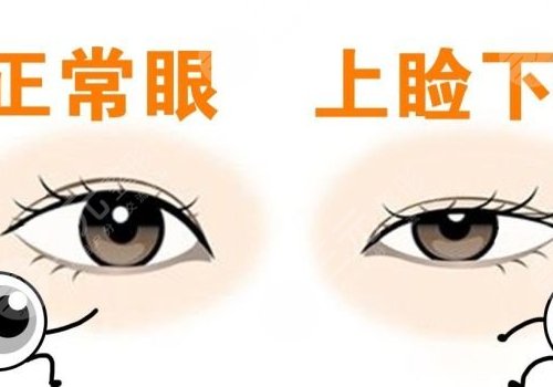 上睑下垂矫正手术有风险吗？