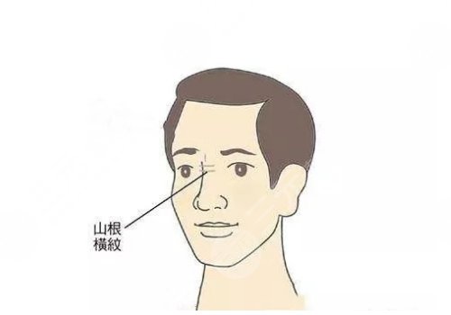 山根有横纹是怎么回事？