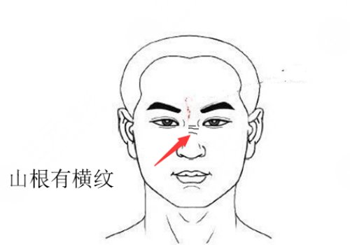 山根有横纹是怎么回事？