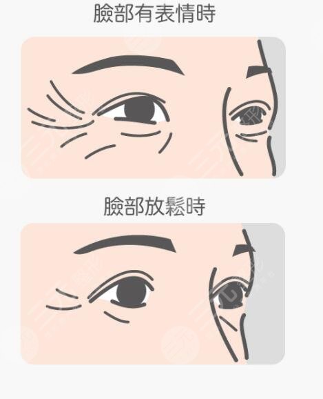 激光去鱼尾纹彻底吗?