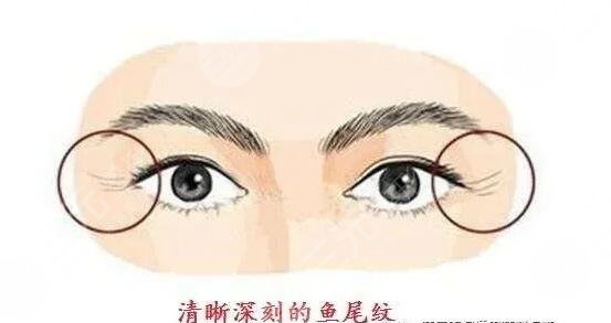 激光去鱼尾纹彻底吗?