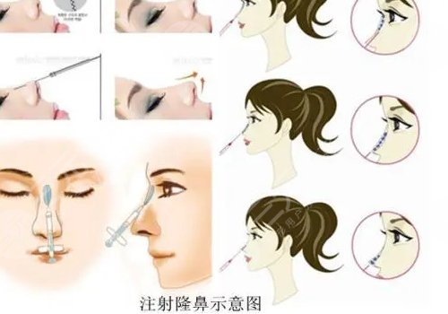 爱贝芙隆鼻可以维持多久？