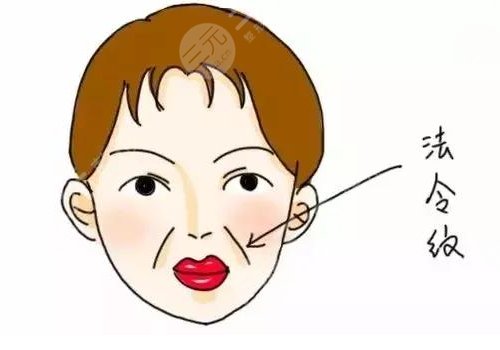 玻尿酸填充法令纹能管多久？