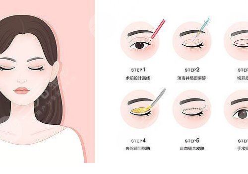 双眼皮全切恢复期要多久？