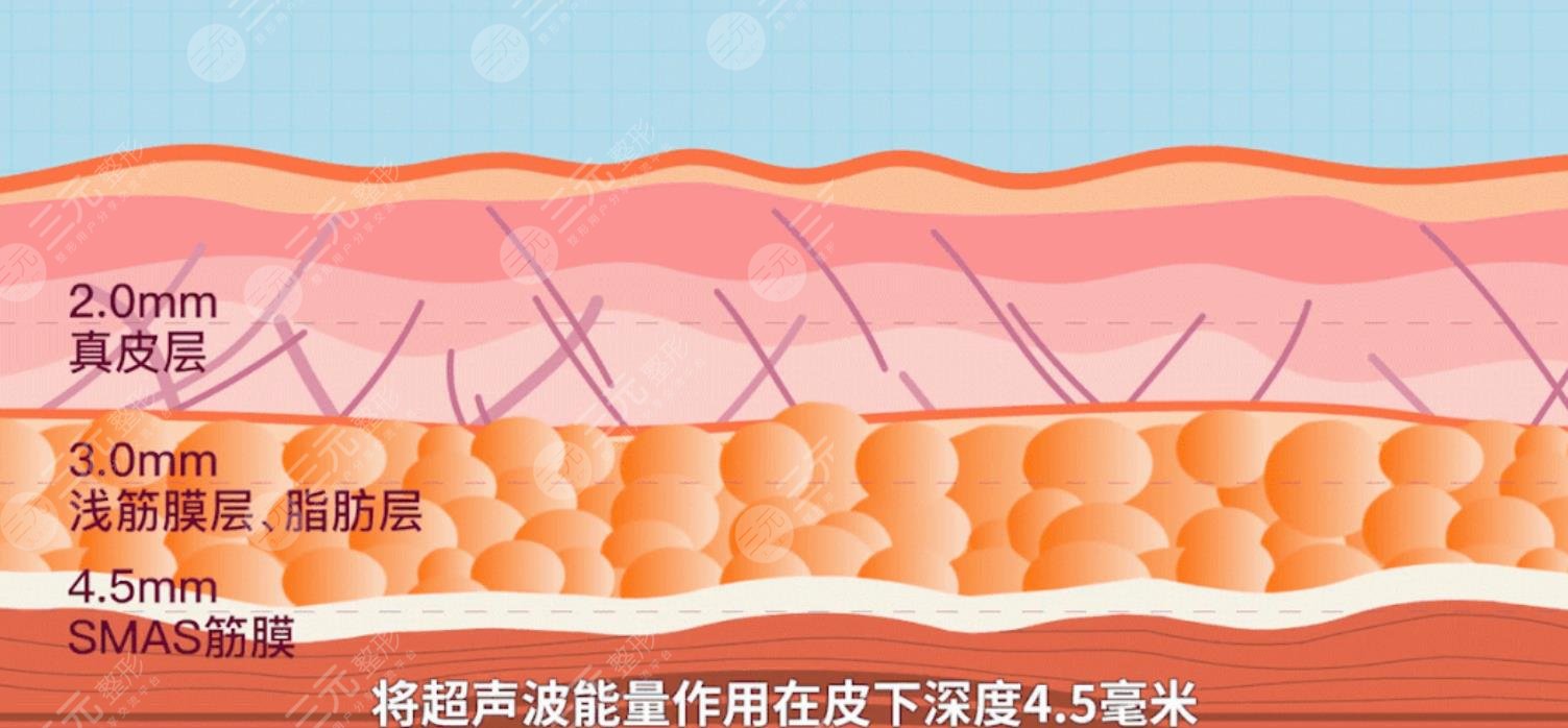 超声炮