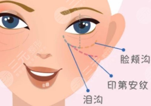 玻尿酸填充泪沟可以维持多久时间