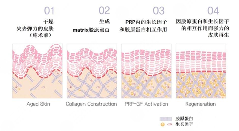 胶原蛋白填充泪沟维持多久？