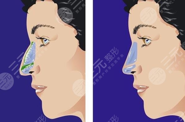 假体隆鼻后遗症有哪些？有哪些表现？假体隆鼻术后的注意事项有哪些？