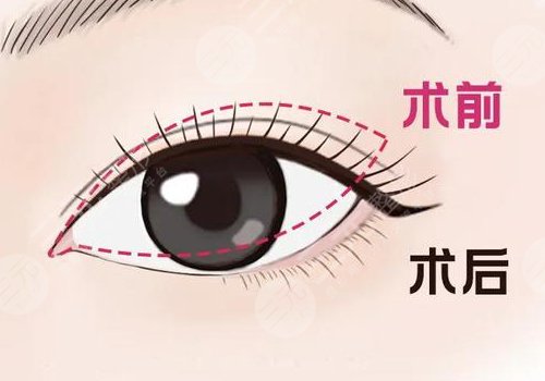 开内眼角要多久恢复