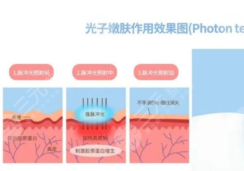 黑脸娃娃跟光子嫩肤有什么区别?