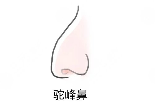 驼峰鼻矫正手术多少钱？