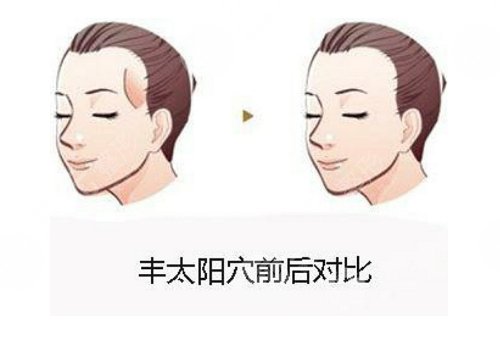 填充太阳凹陷脂肪能保持多久?