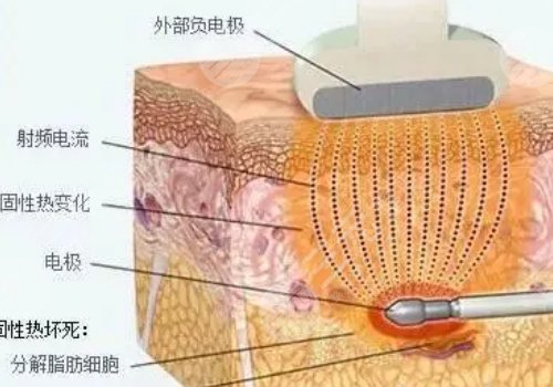 黄金热拉提多少钱一次