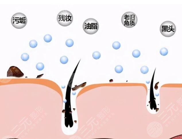 脸部毛孔粗大做什么医美项目比较好?