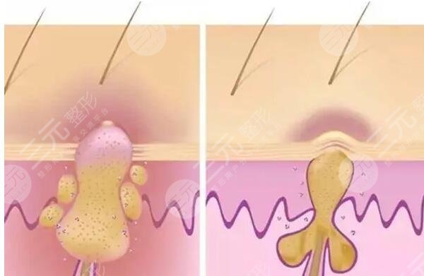 医美治疗脸部毛孔粗大后需要注意什么?