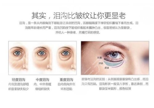 玻尿酸填充泪沟好不好？