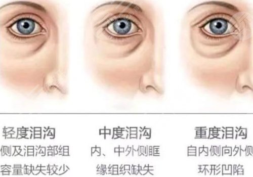 玻尿酸填充泪沟好不好？